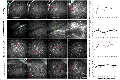 Imaging mitochondrial dynamics in human skin reveals depth-dependent hypoxia and malignant potential for diagnosis.